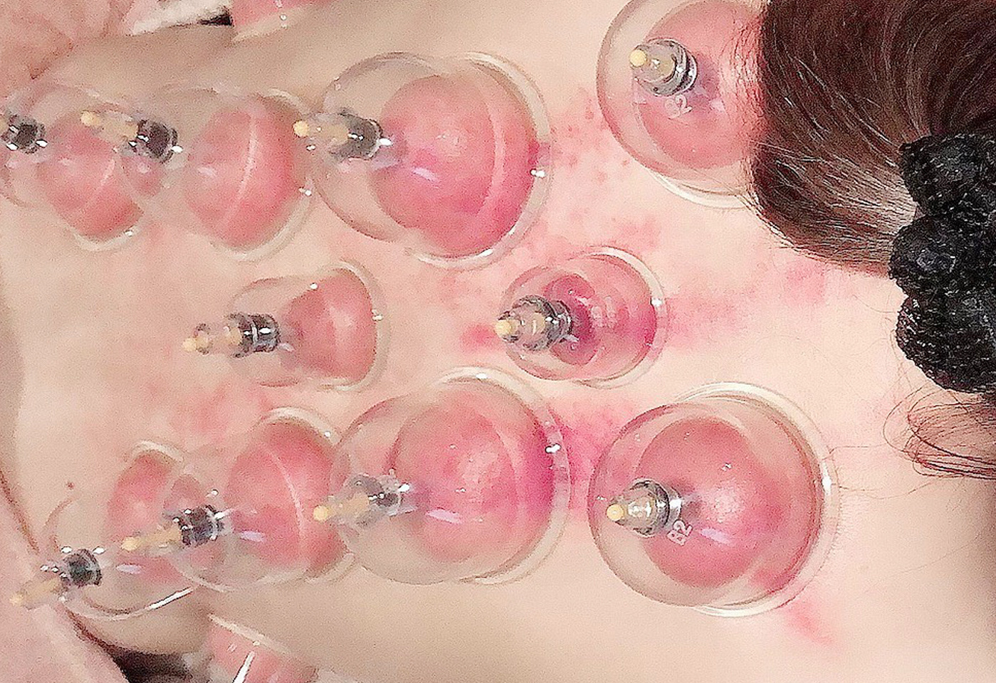 カッサ・カッピング画像