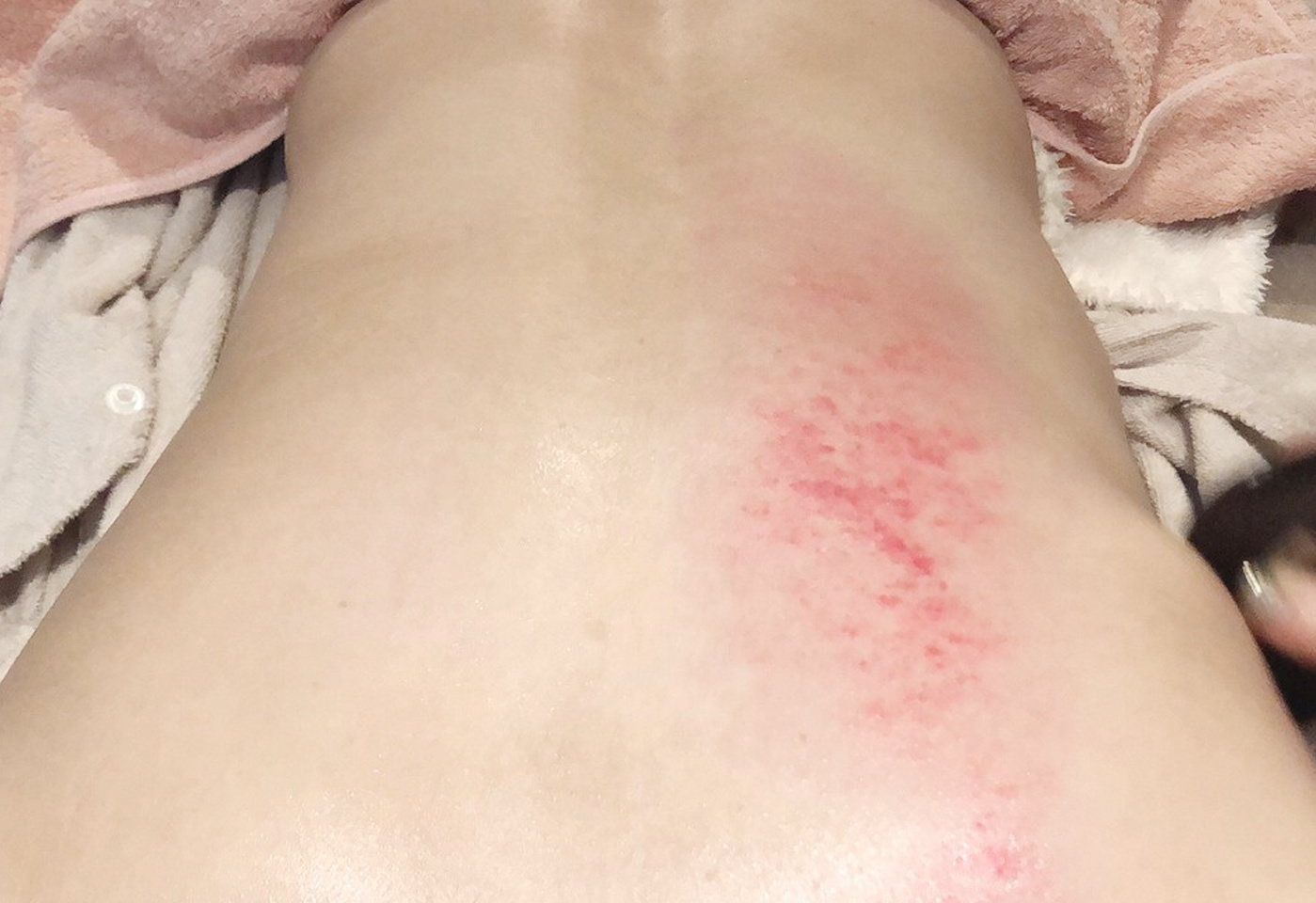 カッサ・カッピング画像