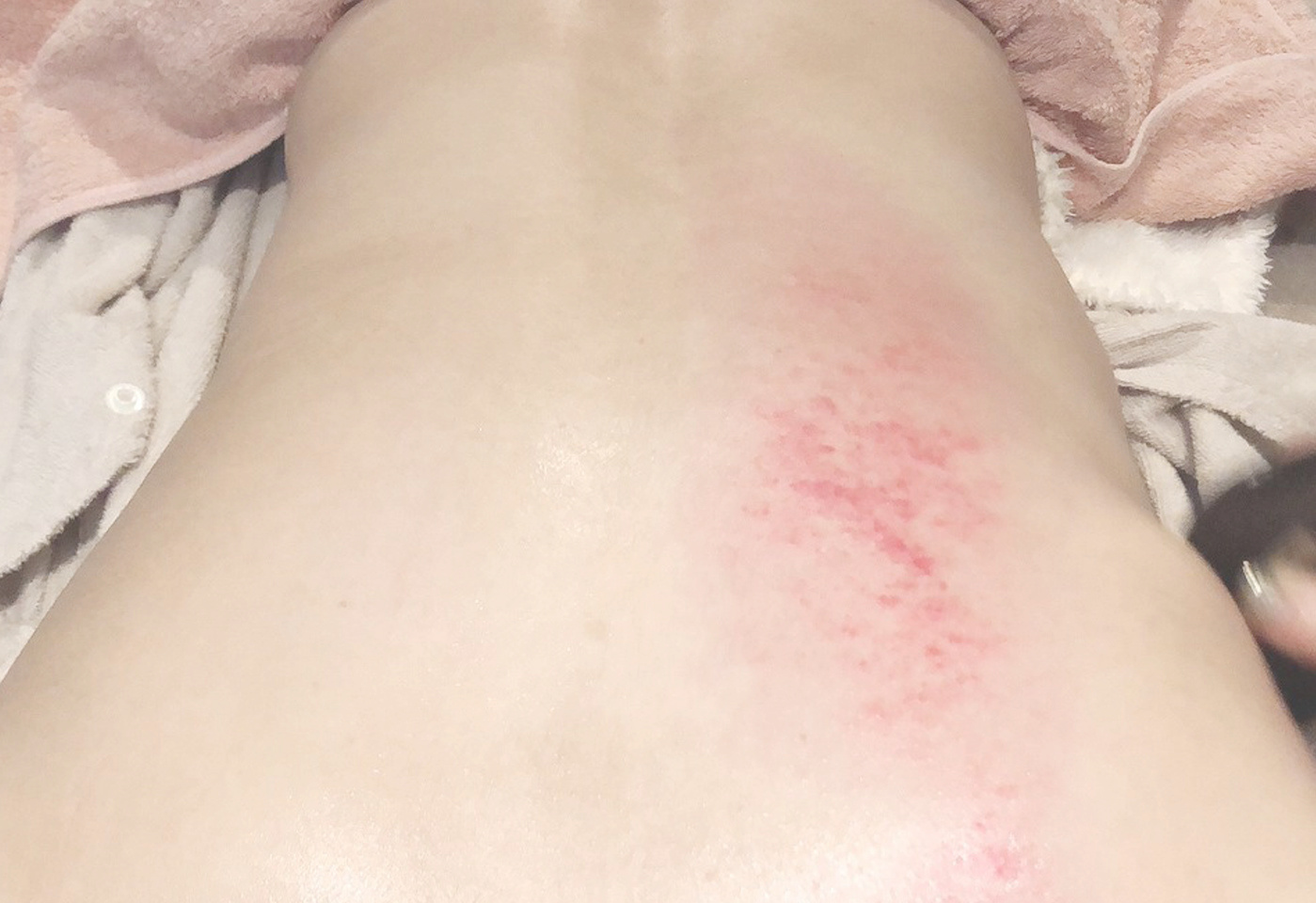 カッサ・カッピング画像